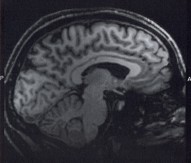 MRI head scan