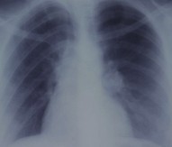 H2020 funds Epigenomics’s lung cancer biomarkers study