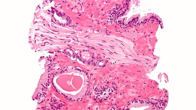 Micrograph showing a prostate cancer (conventional adenocarcinoma) with perineural invasion