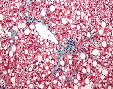 Micrograph of non-alcoholic fatty liver disease