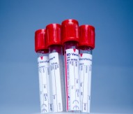 New prostate cancer test method